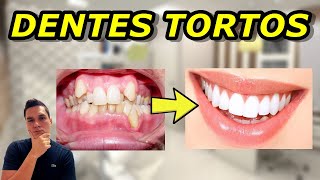 COMO QUE O DENTISTA CORRIGE DENTES TORTOS OU APINHAMENTO DENTÁRIO  EXPLICAÇÃO RESUMIDA [upl. by Cicely86]