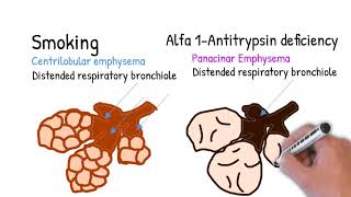 Emphysema  simply explained centrilobular and panacinar emphysema [upl. by Sager299]