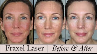 Fraxel Face Laser  Before amp After 3 Month Update [upl. by Elaval]