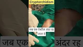 Cryptorchidism l Dr Umar Khan [upl. by Aiek821]