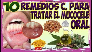 10 Remedios Caseros para Tratar el Mucocele Oral [upl. by Lindahl567]