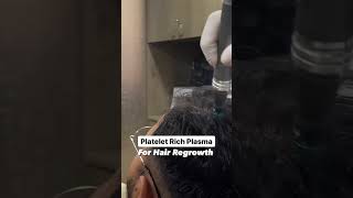 PRP Hair Treatment for Fuller Healthier Hair  PRP Results Before amp After prp [upl. by Loralie]