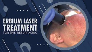 Erbium Laser Treatment for Skin Resurfacing  Beverly Hills CA [upl. by Gitlow]