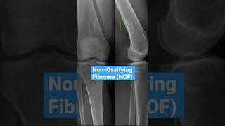 NonOssifying Fibroma bones radiology knee [upl. by Adnert]