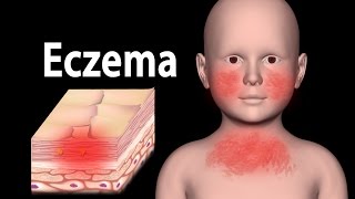 Eczema Animation [upl. by Drhcir379]