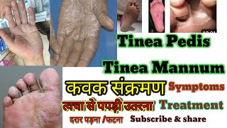 How to treat Tinea Pedis Tinea Mannum कवक संक्रमण त्वचा से पपड़ी उतरना Fungus Infection Traetment [upl. by Eardnaed]