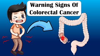 Warning Signs Of Colon Cancer  What Are The Early Signs amp Symptoms Of Colon Cancer [upl. by Socrates367]