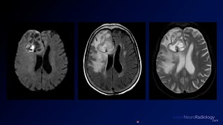 Neuroradiology Board Review  Brain Tumors  Case 1 [upl. by Tham]