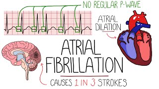 Atrial Fibrillation Made Easy Complete Overview [upl. by Nosirrag]