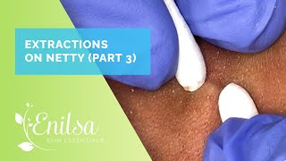 More Blackhead Extractions on Netty  Third Treatment [upl. by Yelruc]