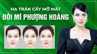 Tư vấn thẩm mỹ HẠ TRÁN và CẤY MỠ MẶT giúp khuôn mặt trở nên baby trẻ trung hơn  Nhã Lê JT Angel [upl. by Anilyx679]