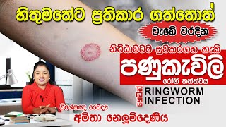 පණුකැවිලි රෝගය හෙවත් Ringworm infection සදහා ප්‍රතිකාර  Skin Specialist [upl. by Demmahom]