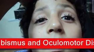 Chronic Progressive External Ophthalmoplegia  شلل عضلات العين [upl. by Nodal]