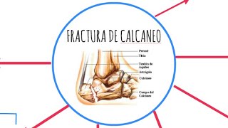 Fractura del calcaneo 👣 indicaciones👉 inflamación  aumentar movimiento [upl. by Raji498]