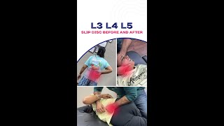 Transform Your Life Say Goodbye to Slipped Disc Pain L3L5  ChiroPhysio Clinic [upl. by Vento678]