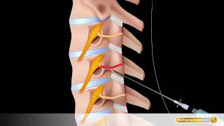 Wirbelsäule Schmerztherapie bei Zervikaler Seitenastblockade HWS [upl. by Woodie64]