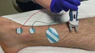 Saphenous Nerve Conduction Studies Proximal and Distal techniques [upl. by Urias267]