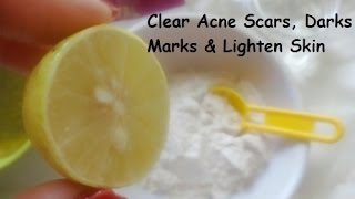 Clear Acne Scars Dark Marks and Lighten Skin in 1 Week [upl. by Akers]