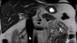 How to read an MRI of the abdomen  First Look MRI [upl. by Pell]