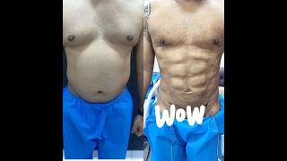 Vaser Liposuction before After Results by Dr Amin Yousaf vaserlipo liposuctionrecovery [upl. by Gerianna391]