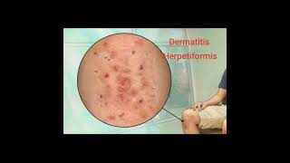 🍁 Dermatitis Herpetiformis 🍁 [upl. by Woodhouse]