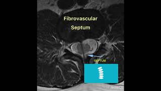 Always look at these findings in a case of spinal dysraphism  Dr Gaurav Vashisht radiology health [upl. by Quintina184]