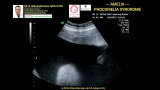 Amelia  Phocomelia syndrome [upl. by Berthold]