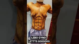 GYNECOMASTIA SURGERY LETSSS GOOO PITTSBURGH PENNSYLVANIA MALE Vaser LIPO GLAND REMOVAL amp RENUVION [upl. by Boehike906]