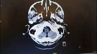 SYNAPSE 101 How to read a CT Brain [upl. by Ringe]