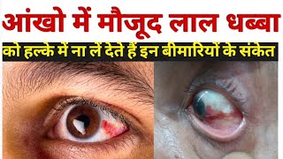 आंख लाल होने का कारण  subconjunctival hemorrhage in hindi  subconjunctival hemorrhage treatment [upl. by Atela750]