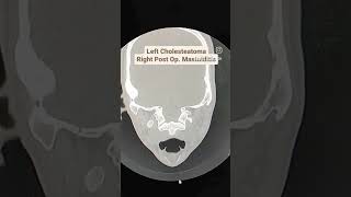 Cholesteatoma with Mastoiditis CT Temporal Bones [upl. by Rebmac393]