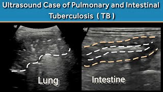 A Rare Case of Active Pulmonary and Intestinal Tuberculosis TB  in One Patient  Ultrasound [upl. by Lleynad]