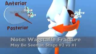 Ankle Fracture SER Supination External Rotation Eversion [upl. by Aenat]