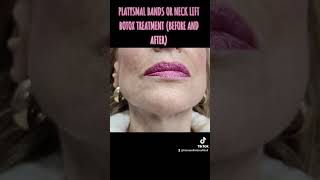 PLATYSMAL BANDS OR NECK LIFT BOTOX TREATMENT BEFORE AND AFTER [upl. by Deborath]