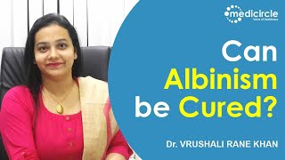 Can Albinism be cured  Treatment for Albino Child  Dr Vrushali Rane Khan [upl. by Racklin919]