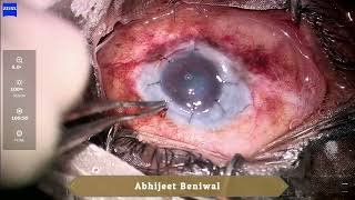 Optical penetrating keratoplasty in Xeroderma Pigmentosum [upl. by Beck]