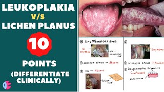 Leukoplakia Vs Lichen planus  Signs of leukoplakia  Signs of lichen planus  Leukoplakia tongue [upl. by Enneyehs]