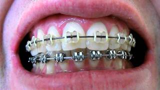 Braces with Black Finishing Wire [upl. by Etnauq]