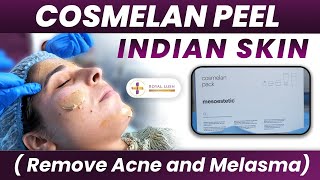 Cosmelan Peel Procedure in India  Cosmelan Peel Treatment Before and After for Melasma Dark Skin [upl. by Sabanrab]