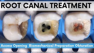 Root Canal Treatment🔵Mandibular 2nd Molar🟡Access Opening🟢 Biomechanical Preparation⚪️Obturation [upl. by Bard]