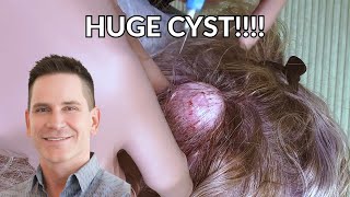 Watch MASSIVE Cyst Get Excised from Patients Head  CONTOUR DERMATOLOGY [upl. by Hsejar]