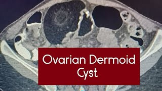 Ovarian Dermoid Cyst Teratoma  most common ovarian neoplasm  ovariancysts dermoid radiology [upl. by Matti]