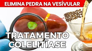 PEDRA NA VESÍCULA sintomas e como eliminar os cálculos Colelitíase SILENCIOSA [upl. by Aicatsal]