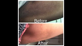 Get rid of dark inner thighs in just 5 days very easy home remedy homeremedy darkinnerthighs [upl. by Trakas]