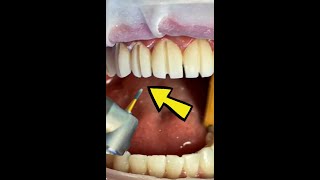 What You Need To Know About Veneers [upl. by Stepha]