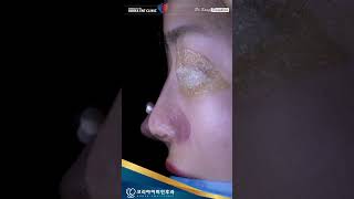 복코 교정을 위한 코성형  asian rhinoplasty for bulbous tip [upl. by Kaylyn]