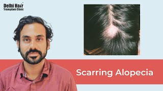 Scarring Alopecia Diagnosis amp Treatment  DHTC  Dr Mukesh Manjhi [upl. by Nwonknu]