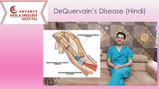 DeQuervains Disease का इलाज़ Hindi India [upl. by Gamin]