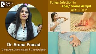 FUNGAL INFECTION in your TOES GROIN ARMPIT Causes Symptoms and Treatment  Dr Aruna Prasad [upl. by Baggs]