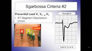 Sgarbossa Criteria and Left Bundle Branch Block [upl. by Ermentrude757]